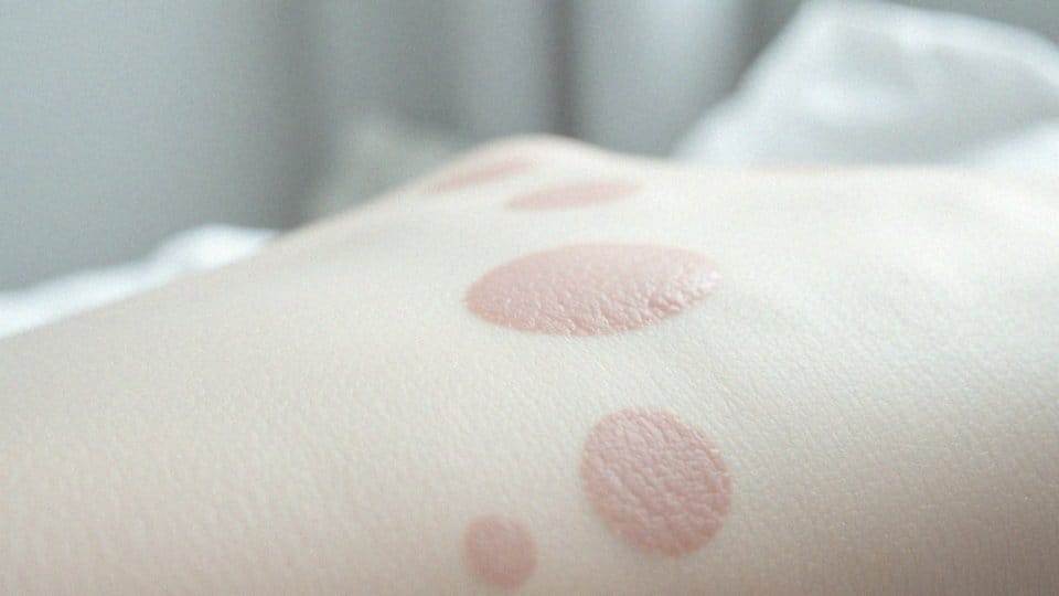 Jakie są etapy powstawania blizny po oparzeniu?
