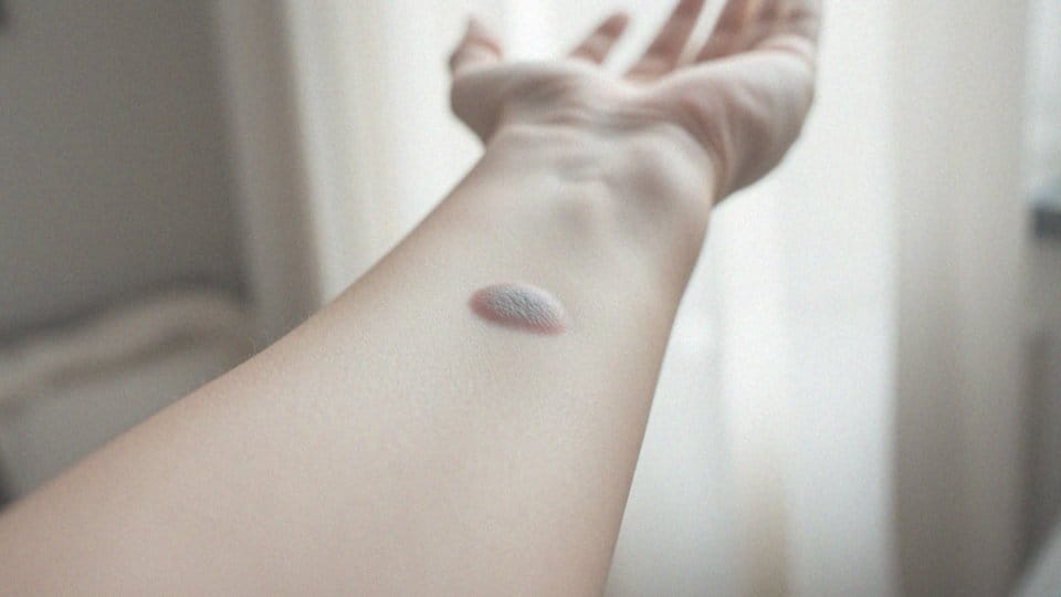 Gojenie po wymrażaniu kurzajki – najważniejsze etapy i zalecenia